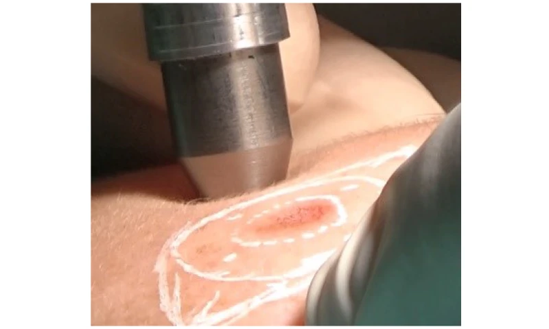 SpectroLive : spectres optiques (autofluorescence et réflectance diffuse) acquis sur des carcinomes cutanés humains